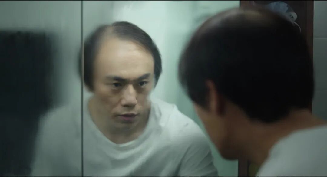 韩国治脱发拟纳入医保，多少男人羡慕了